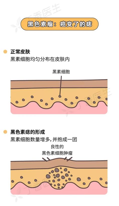 身上痣|痣也可能会癌变！长在 3 个地方要注意